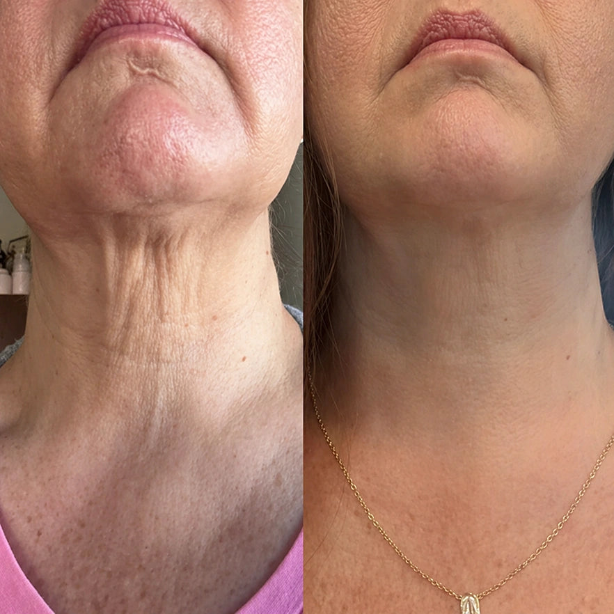 Antes y después en el cuello con Rejuvelia