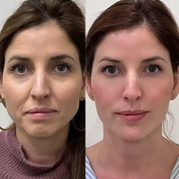 Antes y después
